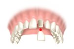 Tooth Veneers